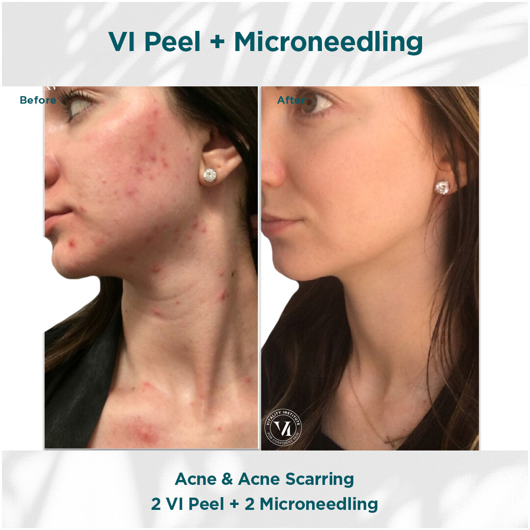 VI Peel Micre Needling B _ A