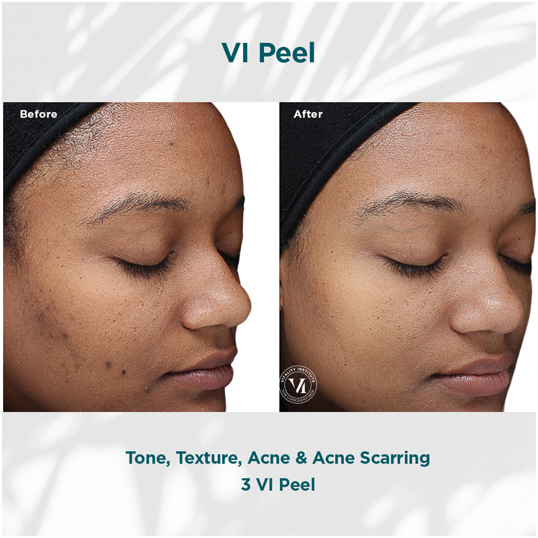 VI Peel Tone, Texture, Acne _ Acne Scarring