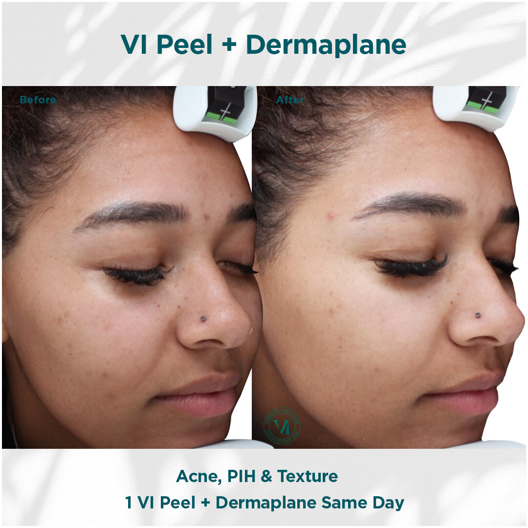 VI Peel and Dermaplane B _ A