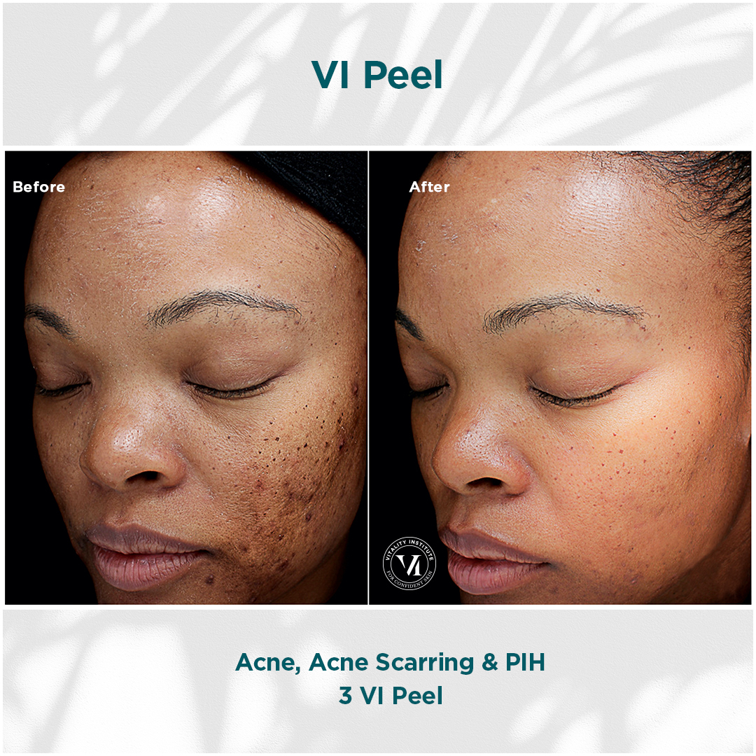 Vi Peel Acne, Scarring _ PIH_01