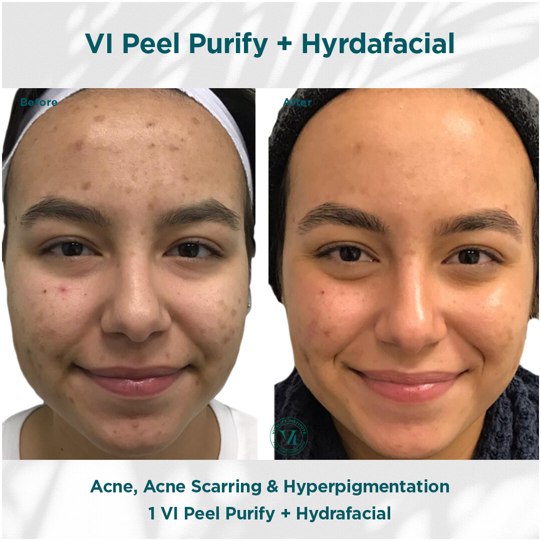 Vi Peel and Hydrafacial